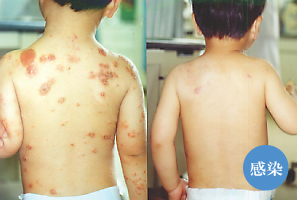 幼児によくみられる感染を伴い悪化した湿疹　写真